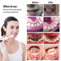 G6 Ultrasonic Dental Calculus Remover Teeth Plaque Scaler Tartar Eliminator Stains Cleaner Electric Dental Tooth Stone Remover